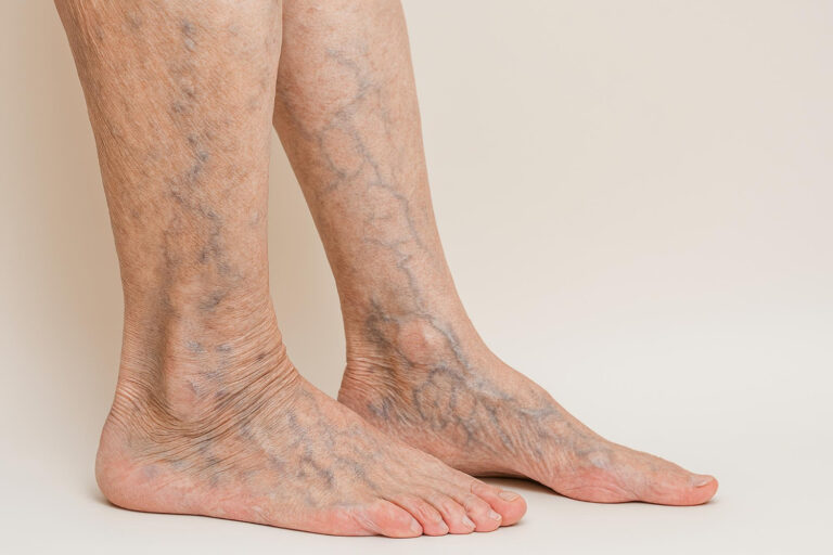 Varicose Veins